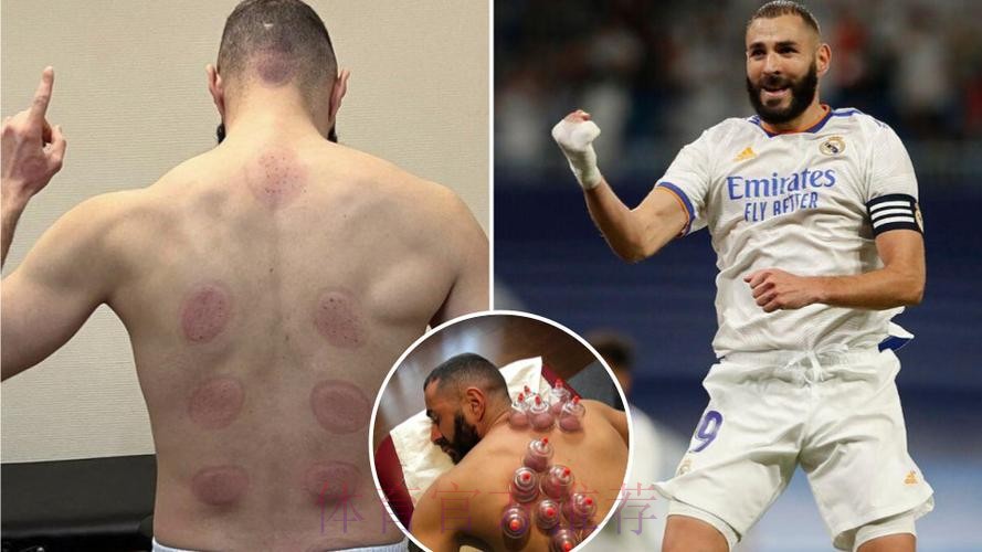 本泽马假期期间每天训练 今天接受了拔罐理疗